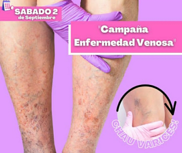 CAMPA&Ntilde;A DE DIAGN&Oacute;STICO, PREVENCI&Oacute;N Y TRATAMIENTO EN FLEBOLOG&Iacute;A