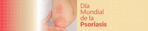 29 de Octubre D&iacute;a Mundial de la Psoriasis: c&oacute;mo reconocer la enfermedad