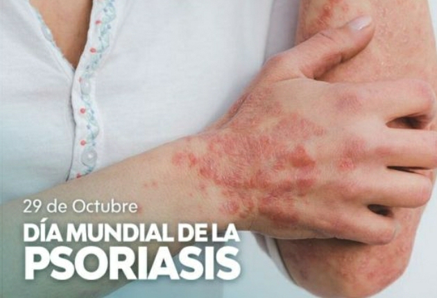 D&Iacute;A MUNDIAL DE LA PSORIASIS, UNA ENFERMEDAD QUE SIGUE SIENDO ESTIGMATIZANTE